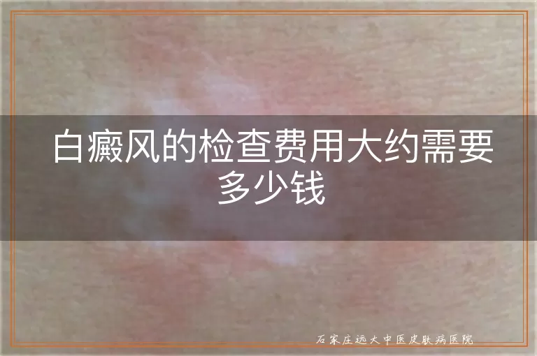 白癜风的检查费用大约需要多少钱