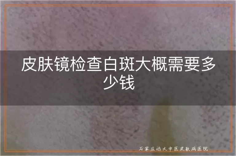 皮肤镜检查白斑大概需要多少钱