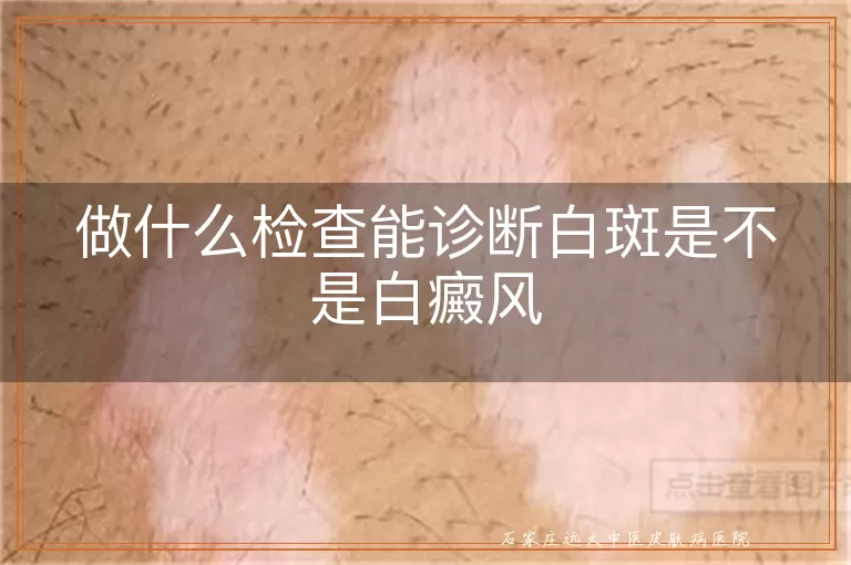 做什么检查能诊断白斑是不是白癜风