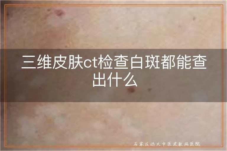 三维皮肤ct检查白斑都能查出什么