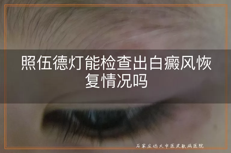 照伍德灯能检查出白癜风恢复情况吗
