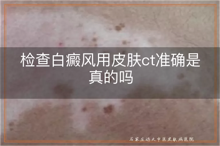 检查白癜风用皮肤ct准确是真的吗