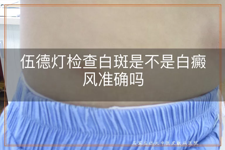 伍德灯检查白斑是不是白癜风准确吗