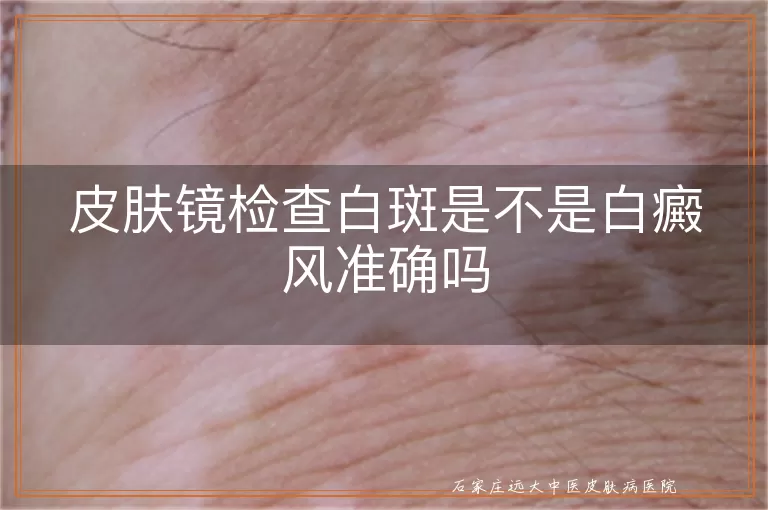 皮肤镜检查白斑是不是白癜风准确吗