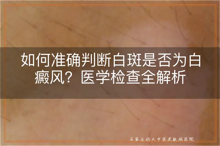 如何准确判断白斑是否为白癜风？医学检查全解析
