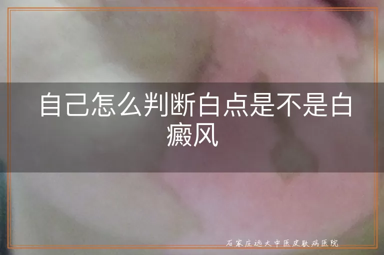 自己怎么判断白点是不是白癜风
