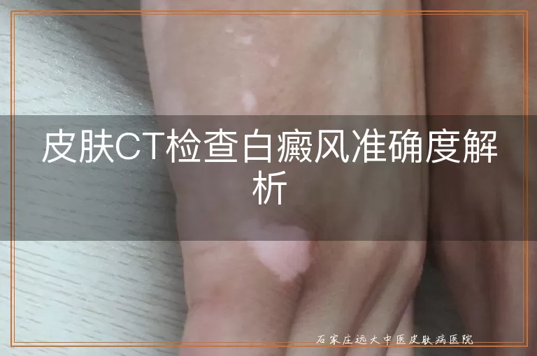 皮肤CT检查白癜风准确度解析