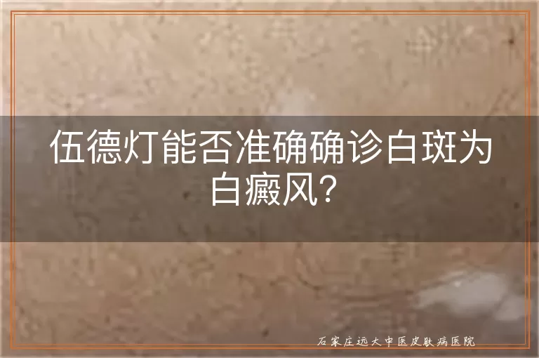 伍德灯能否准确确诊白斑为白癜风？
