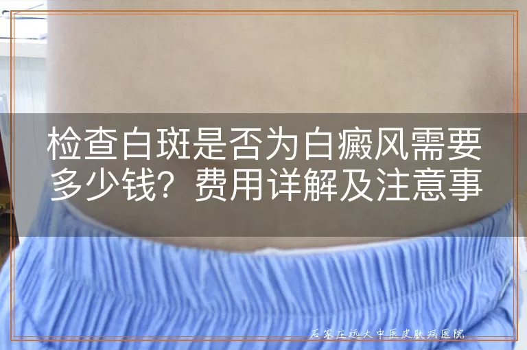 检查白斑是否为白癜风需要多少钱?费用详解及注意事项