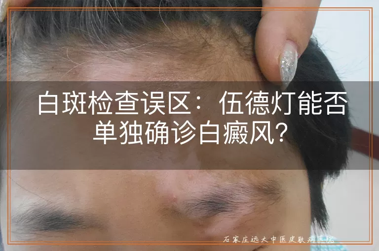 白斑检查误区：伍德灯能否单独确诊白癜风？