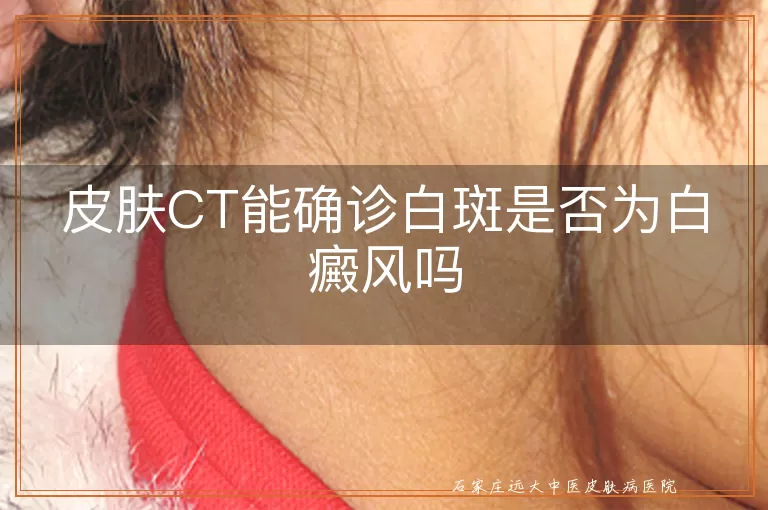 皮肤CT能确诊白斑是否为白癜风吗