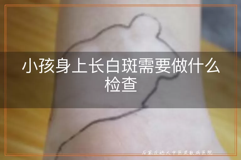 小孩身上长白斑需要做什么检查