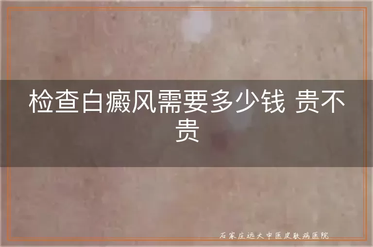 检查白癜风需要多少钱 贵不贵