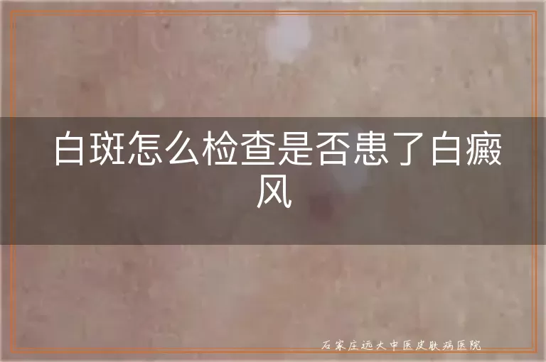 白斑怎么检查是否患了白癜风