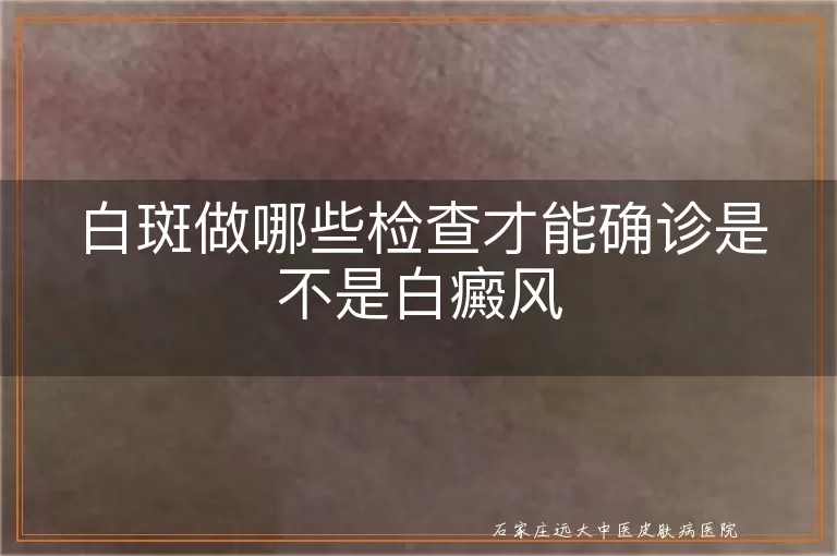 白斑做哪些检查才能确诊是不是白癜风