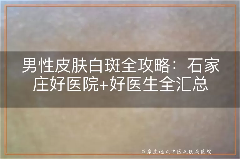 男性皮肤白斑全攻略：石家庄好医院+好医生全汇总