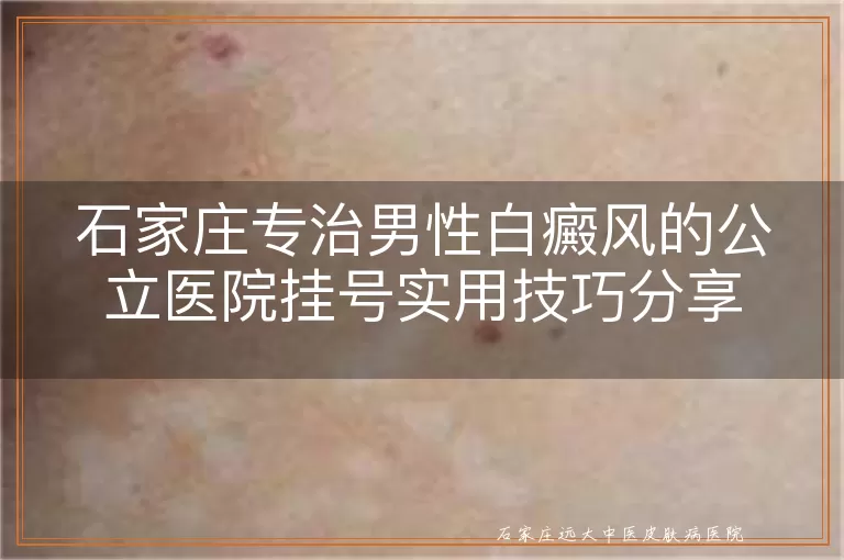 石家庄专治男性白癜风的公立医院挂号实用技巧分享