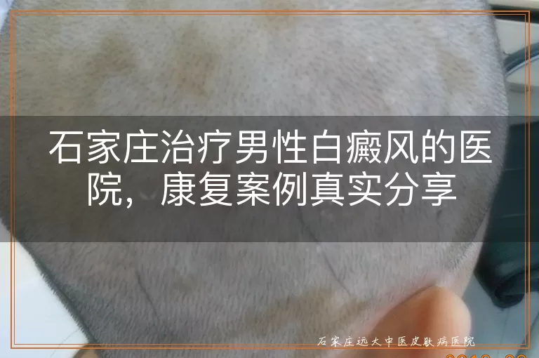 石家庄治疗男性白癜风的医院，康复案例真实分享
