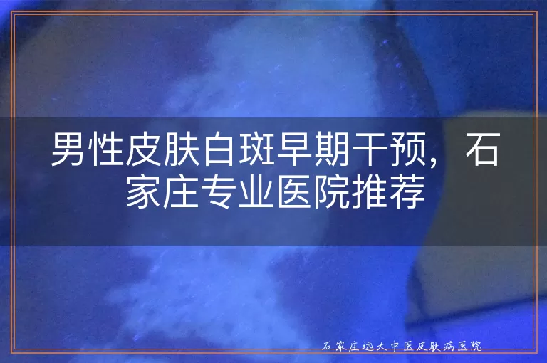男性皮肤白斑早期干预,石家庄专业医院推荐