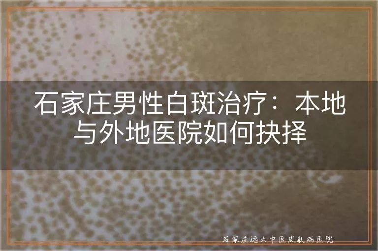 石家庄男性白斑治疗:本地与外地医院如何抉择