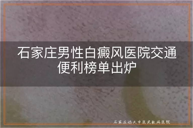 石家庄男性白癜风医院交通便利榜单出炉