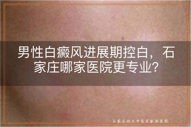 男性白癜风进展期控白，石家庄哪家医院更专业？