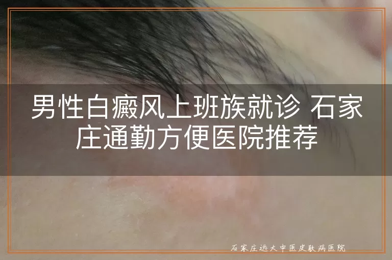 男性白癜风上班族就诊 石家庄通勤方便医院推荐