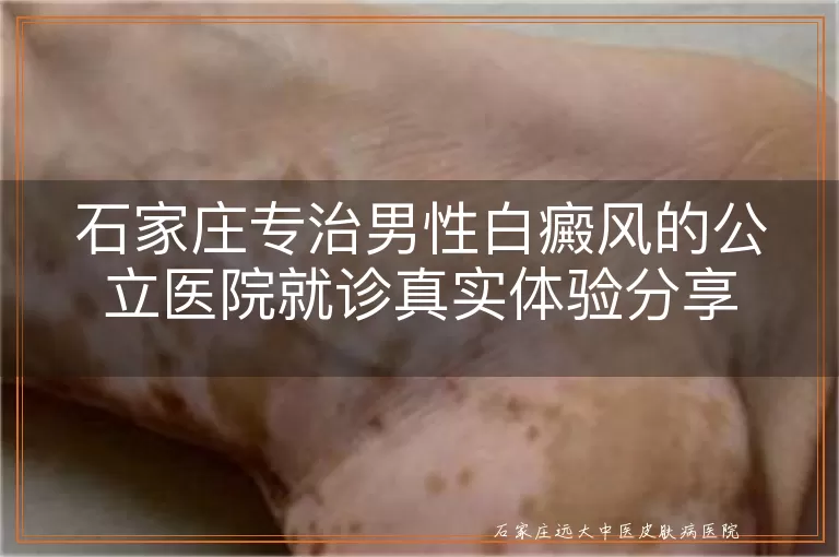 石家庄专治男性白癜风的公立医院就诊真实体验分享