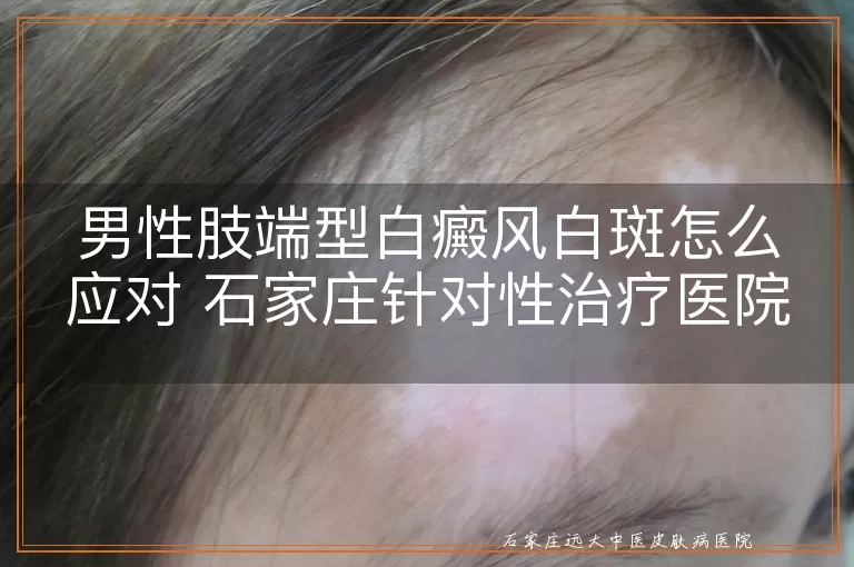 男性肢端型白癜风白斑怎么应对 石家庄针对性治疗医院