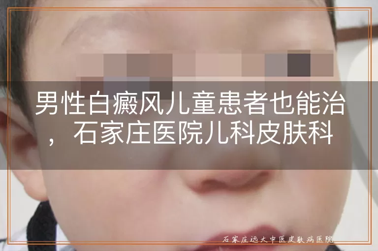 男性白癜风儿童患者也能治，石家庄医院儿科皮肤科