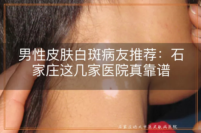 男性皮肤白斑病友推荐：石家庄这几家医院真靠谱