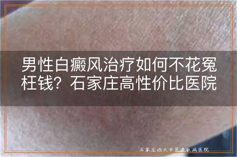 男性白癜风治疗如何不花冤枉钱？石家庄高性价比医院推荐