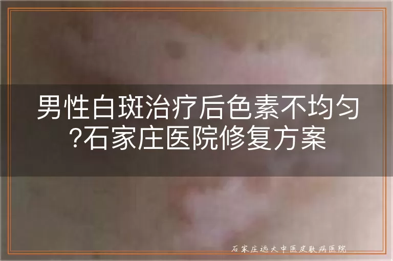 男性白斑治疗后色素不均匀?石家庄医院修复方案