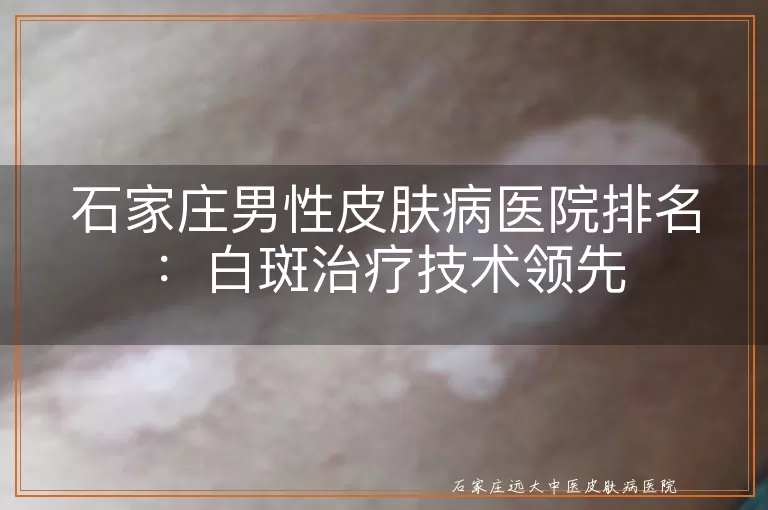 石家庄男性皮肤病医院排名：白斑治疗技术领先