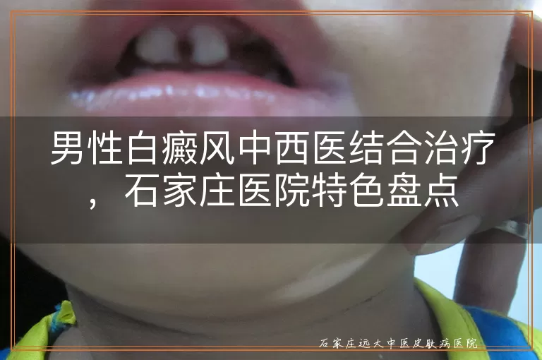 男性白癜风中西医结合治疗,石家庄医院特色盘点