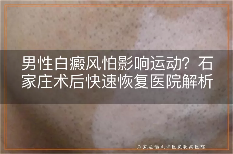 男性白癜风怕影响运动?石家庄术后快速恢复医院解析
