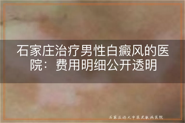 石家庄治疗男性白癜风的医院:费用明细公开透明