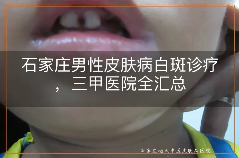 石家庄男性皮肤病白斑诊疗,三甲医院全汇总