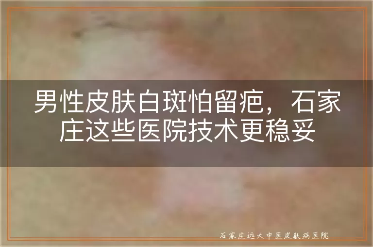 男性皮肤白斑怕留疤，石家庄这些医院技术更稳妥