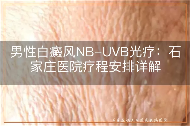 男性白癜风NB-UVB光疗：石家庄医院疗程安排详解