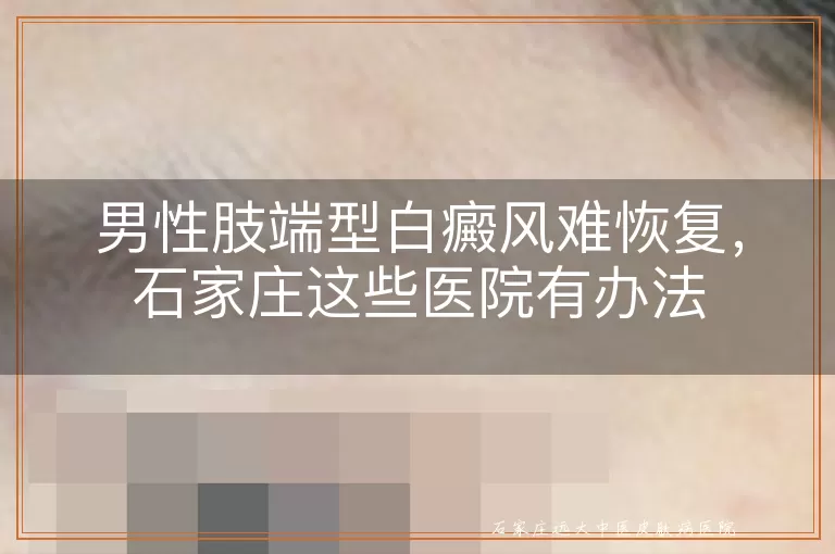 男性肢端型白癜风难恢复，石家庄这些医院有办法