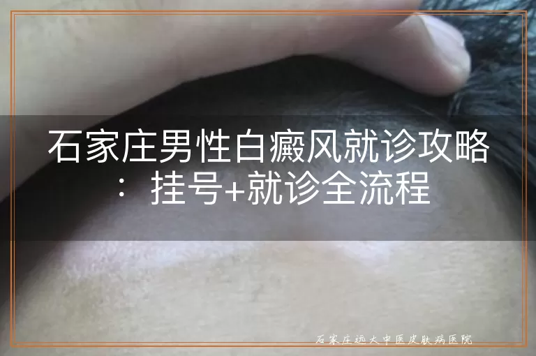 石家庄男性白癜风就诊攻略：挂号+就诊全流程