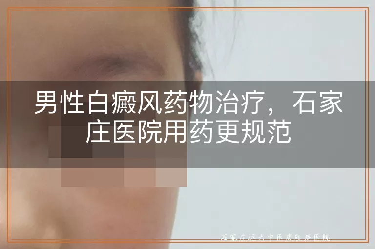 男性白癜风药物治疗，石家庄医院用药更规范