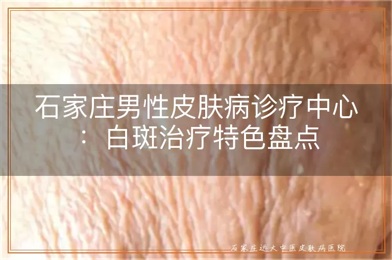 石家庄男性皮肤病诊疗中心：白斑治疗特色盘点