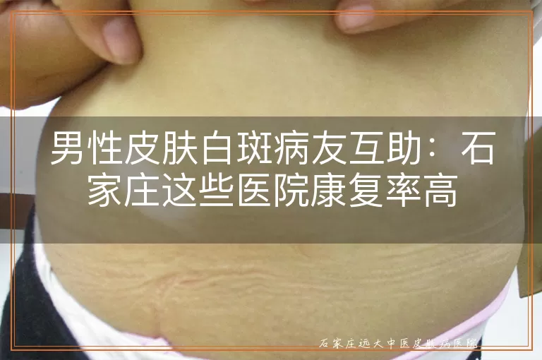 男性皮肤白斑病友互助：石家庄这些医院康复率高