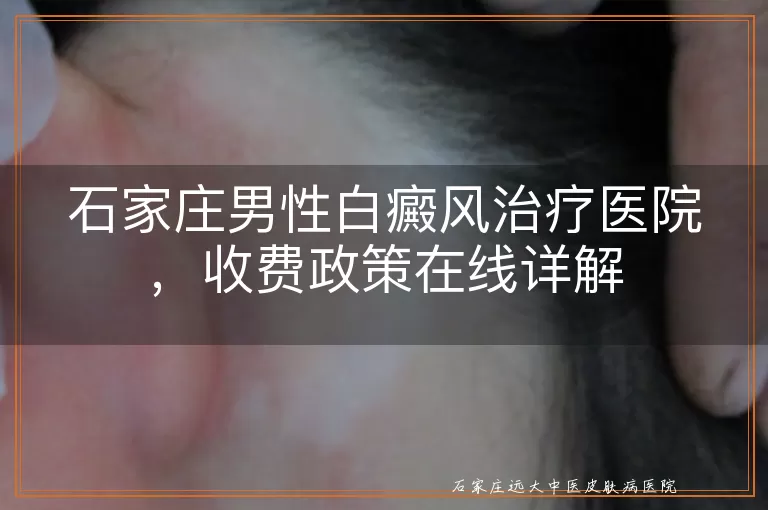 石家庄男性白癜风治疗医院，收费政策在线详解