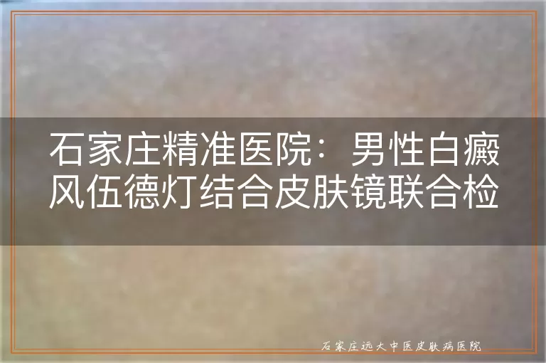 石家庄精准医院：男性白癜风伍德灯结合皮肤镜联合检测有何优势