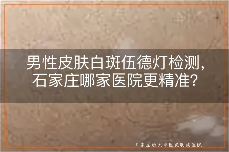 男性皮肤白斑伍德灯检测，石家庄哪家医院更精准？