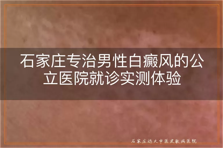 石家庄专治男性白癜风的公立医院就诊实测体验