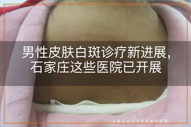 男性皮肤白斑诊疗新进展，石家庄这些医院已开展